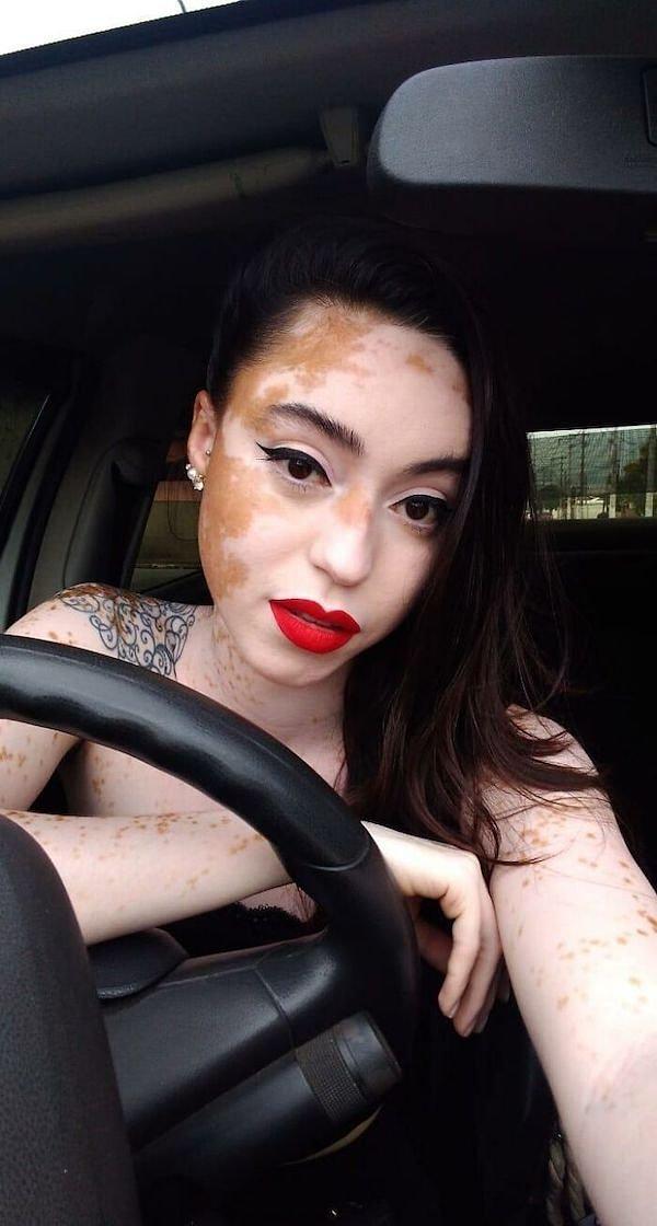 Girl With Vitiligo Show Her Beauty Through Modeling free nude pictures